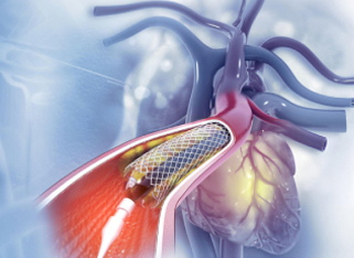 Illustration representing an heart and arteries showing a stent being deployed to treat a blocked artery.