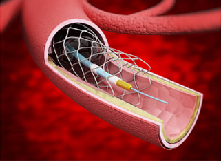 Illustration of a stent inside a blood vessel, demonstrating its structure and placement within the arterial wall