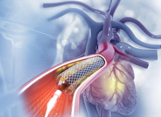 Illustration representing an heart and arteries showing a stent being deployed to treat a blocked artery.