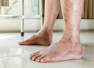 Close-up of aging feet on tiled floor, showcasing dry skin and visible veins
