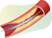 Illustration of blood vessel with plaque buildup
