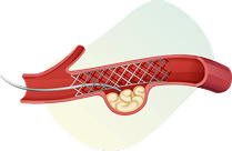 Illustration of blood vessel cross section with plaque buildup